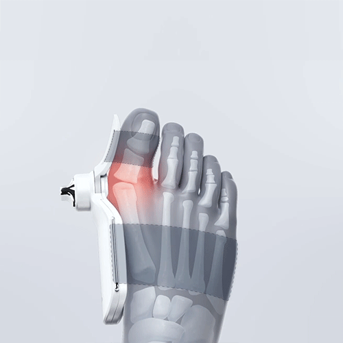 Adjustable angle bunion corrector,hallux valgus,Suitable for Left/Right Feet(1PCS)